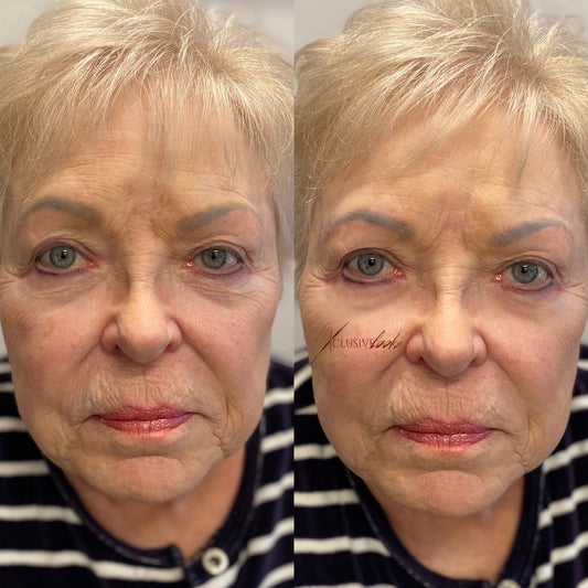 Best Botox Studio in Frisco, Texas